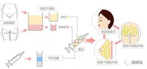 溶脂针最新版，技术革新与应用展望